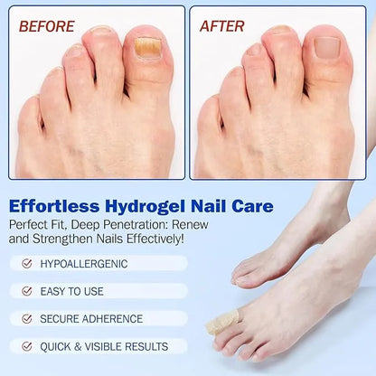 Fungal Nail Treatment Patches – Fast-Acting Antifungal Repair for Healthy Nails